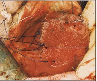 Figure 8 : Photo de la suture d’un patch sur un cœur ischémié (Bowen et al. 2001) 