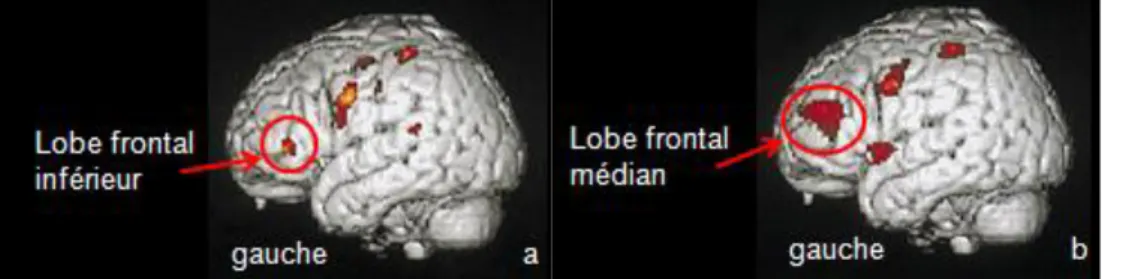 Figure 19 : activation au niveau du lobe préfrontal a) activation du LFI (BA 44) b)  activation corrélée avec l’aspect désagréable de la sensation du LFM (BA 9/10) 