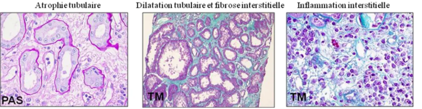 Figure 8 : Histologie des lésions tubulo-interstitielles rénales 
