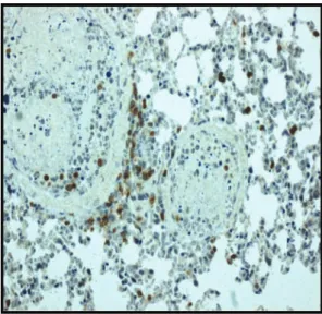 Fig. 2. Infiltration of the mouse lung by human T cells with asso- asso-ciated occlusions of lung vessels (immunohistochemistry staining with an antibody towards human CD3, coupled to peroxidase, ·200).