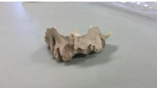 Figure 6 T16 : anomalie dentaire du maxillaire.