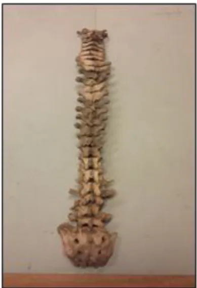 Figure 8 T13 : rachis, lombaire surnuméraire sans compensation.