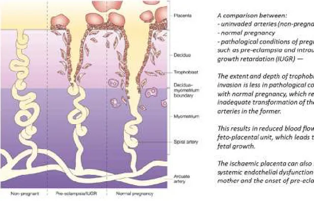 Figure 8: Normal and pathological Human trophoblast invasion and consequences  From Ashley Moffett-King, Nature Reviews Immunology, 2002 