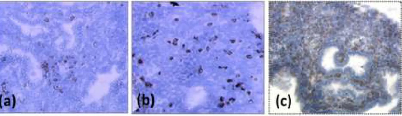 Figure 9: Endometrial uNK immunostaining (CD56+) during middle luteal phase showing a 
