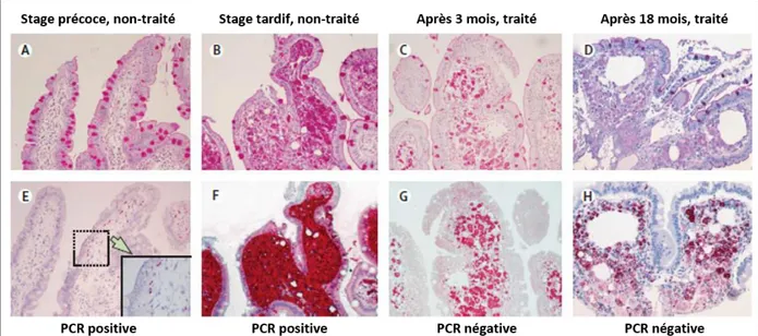 Figure 2: Diagnostic de la MW et conséquences du traitement.  