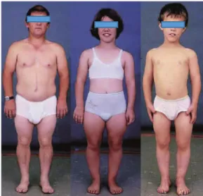Figure  4.  Patients  affected  by  HCH.  These  sufferers  show  a  rhizomelic  dwarfism  less  severe  compared to ACH patients