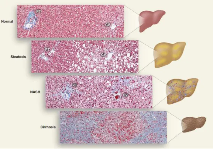 Figure 16 : Etiologie des NAFLD 