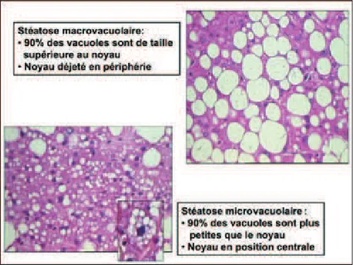Figure 2.1 – La stéatose macrovacuolaire et microvacuolaire [16]