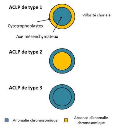 Figure  4.  Illustration  des  différents  types  d’anomalies  chromosomiques  limitées   au placenta (d’après Toutain (Toutain 2012)) 