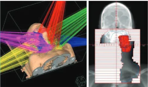 Figure  2.  Illustration  d’un  traitement  par  radiothérapie  conformationnelle  3D  (gauche)  et  du  rôle  du  collimateur  multi-lames  (droite)  qui  permet  d’adapter la forme du faisceau au volume de la tumeur à traiter au cours  d’une séance