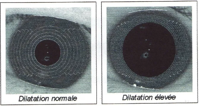 Figure III.9: dilatation normale et dilatation élevée de la pupille 