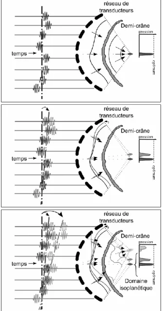 Figure  II-9  Principe  de  l’angulation  électronique  de  faisceaux  ultrasonore  à  travers  le  crâne,  schématisé  ici  pour  des  positions  ciblées  situées  dans  le  plan  focal  de  la  sonde