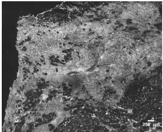 Figure III.4 presents distinct features of a ductal carcinoma in situ (DCIS) showing enlarged  lobules – clusters of distended acini – and ductal structures with narrow lumen