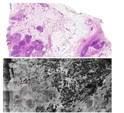 Figure  III.4:  ductal   carcinoma   in  situ (DCIS).   FFOCT  image   (bottom)  along   with   corresponding histology (top)