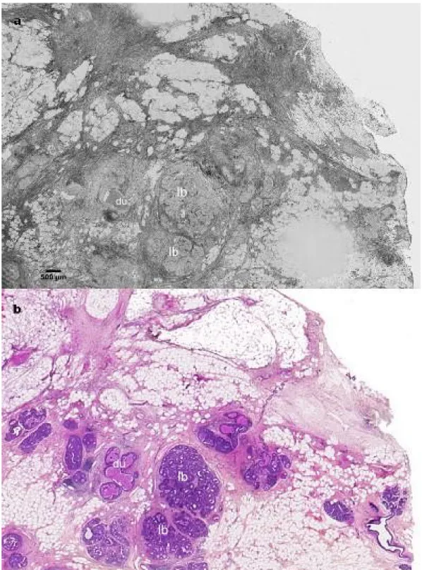 Figure  III.6:  Ductal   Carcinoma   in   situ   (DCIS).   Tomographic   image   a)   and   corresponding   histology section b)