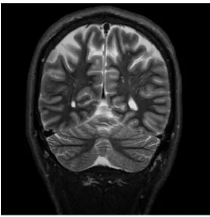 Fig. 1.13 : IRM d’un crâne avec un MAGNETOM Trio de Siemens [Head, TIRM coronal, PAT 2 TR 5980  ms,TE 47 ms, TI 180 ms, TA 2 min, SL 3 mm, slices 38, matrix 384, [Siemens AG]
