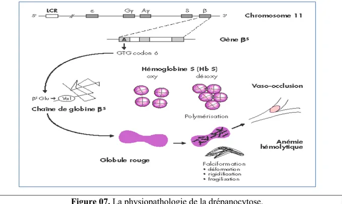 Figure 07. La physiopathologie de la drépanocytose. 