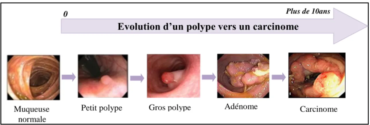 Figure 03 : Evolution du cancer colorectal dans le temps. 