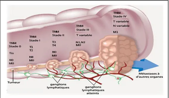 Figure 04 : Représentation schématique des différents stades du cancer colorectal. Tirée du  site : http://www.colorectal-cancer.ca/fr  (Association canadienne du cancer colorectal)