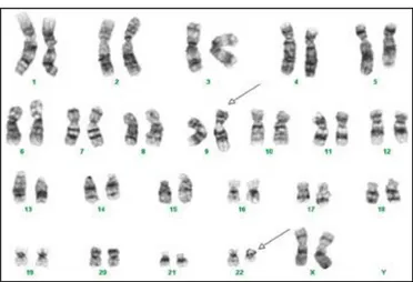 Figure 6:Caryotype médullaire d’un cas de LMC 