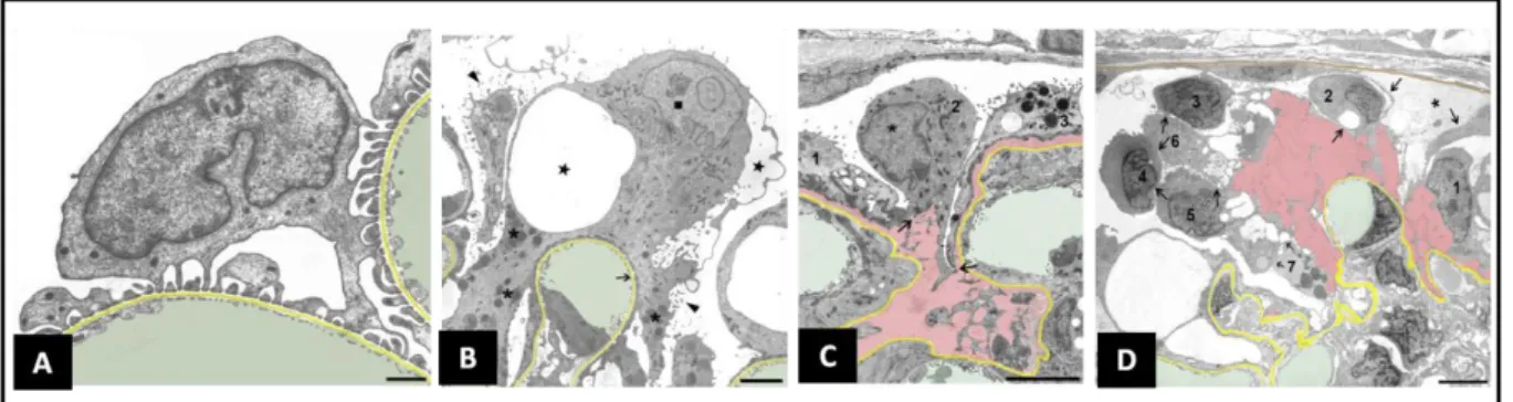 Figure 4. Ultrastructural changes accompanying podocyte injury and detachment. GBM is highlighted in yellow, capillary  lumens  in  green  and  spaces  between  GBM  and  detaching  podocytes  in  pink  (A)  Normal  podocytes  (B)  Podocyte  effacement  in