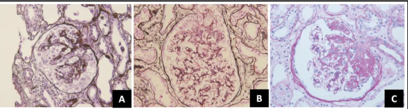 Figure 6. Histologic variants of FSGS. (A) Collapsing variant showing capillary collapse and podocyte hypertrophy (B) Tip  variant showing a segmental lesion of the glomerular tuft next to the urinary pole (C) Peri-hilar variant showing sclerosis  and hyal