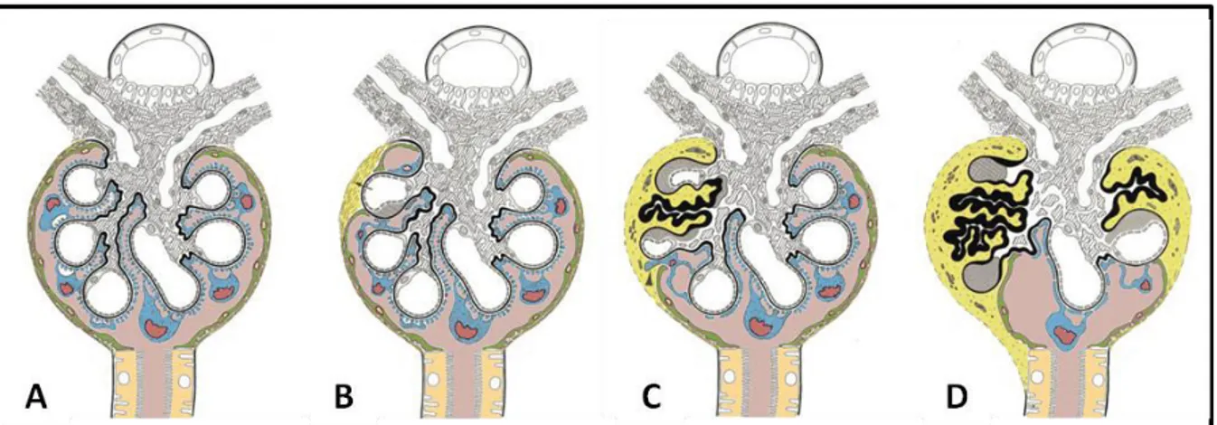 Figure 7. Progression of glomerular diseases.  (A) Normal glomerulus; podocytes are shown in blue, parietal epithelial  cells in green