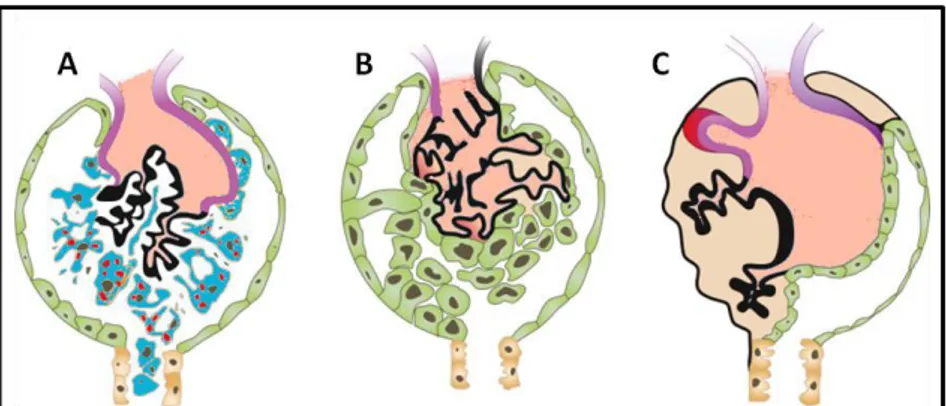 Figure  8.  Parietal  epithelial  cells  participate  in  the  progression  of  glomerulosclerosis