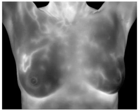 Fig. 1.3 – Exemple de diagnostic d’une tumeur cancéreuse. L’imagerie thermique permet de mettre en valeur la vascularisation développée par la tumeur.