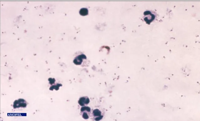 Figure  5 :  Goutte  épaisse  avec  gamétocytes  et  trophozoïtes  de  Plasmodium  falciparum  (Giemsa) [32]
