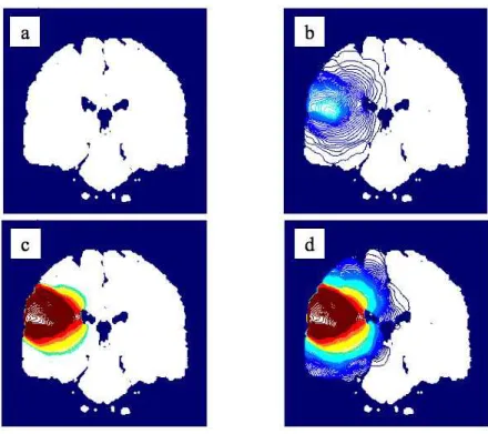 Fig. 1.6 – Simulations de la taille d’un glioblastome : (a et b) environ 400 jours apr`es l’apparition des