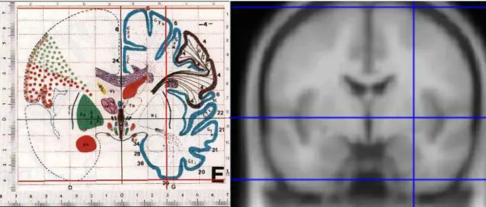 Figure  7.  Illustration  des  différences  morphologiques  observées  entre  les  2  espaces  stéréotaxiques  de  référence Talairach (à gauche) et MNI (à droite)