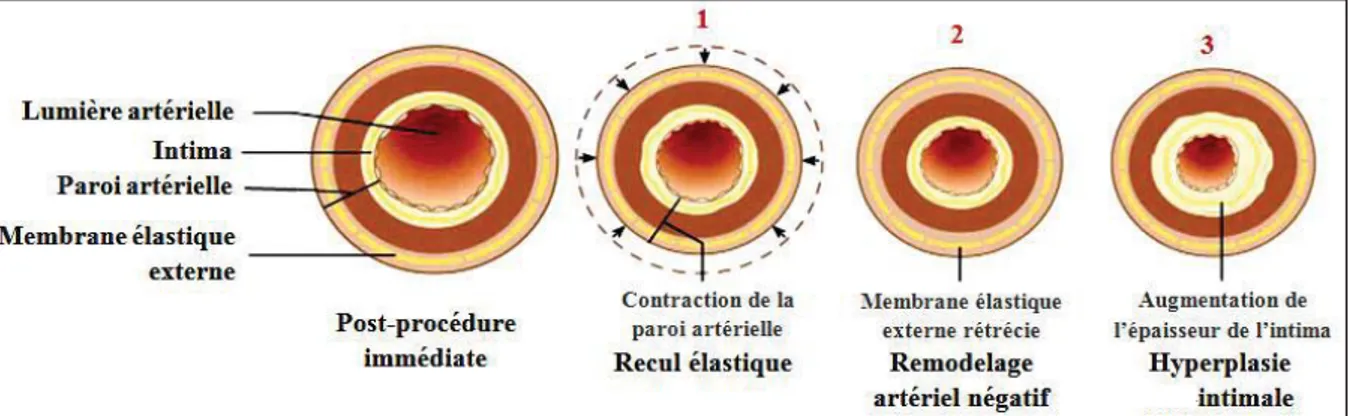 Figure I-12. Physiopathologie de la resténose après angioplastie au ballonnet : remodelage 