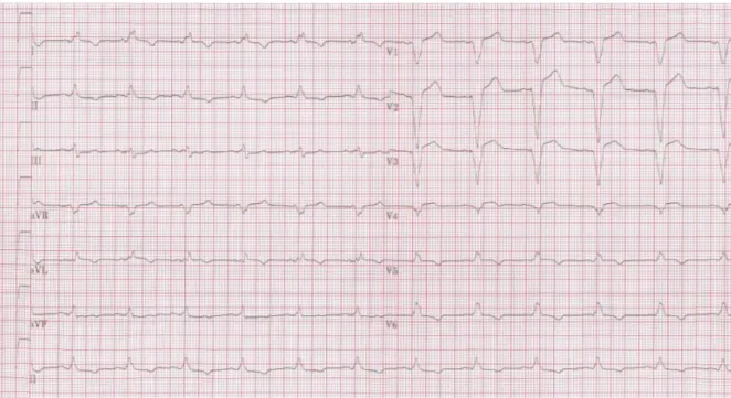 Figure 5.13: Clinical 12-lead ECG signals for a LBBB. Source: www.ecgpedia.org (reproduced with permission).