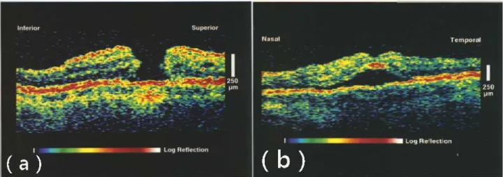 Figure 1.4 – OCT human retinal images indicating macular hole and detachment [15]. (a)OCT image shows a macular hole on the retina.(b) OCT image demonstrates detachment of the neurosensory retina.