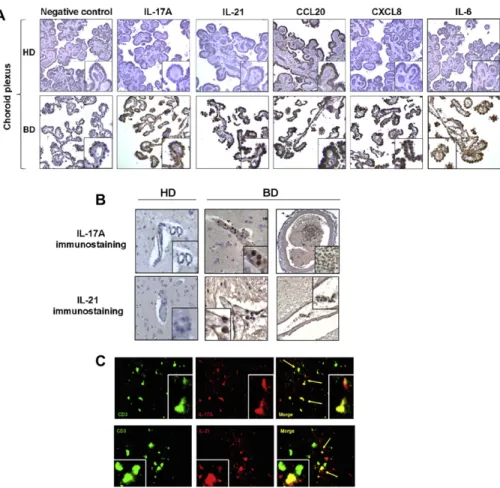 FIG 5. Strong IL-21 and IL-17A expression in CNS inflammatory lesions from patients with BD