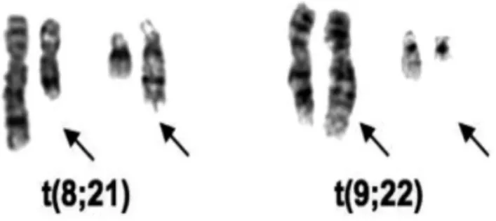 Figure 19 : Caryotypes partiels montrant  les deux  premières translocations associées aux hémopathies 