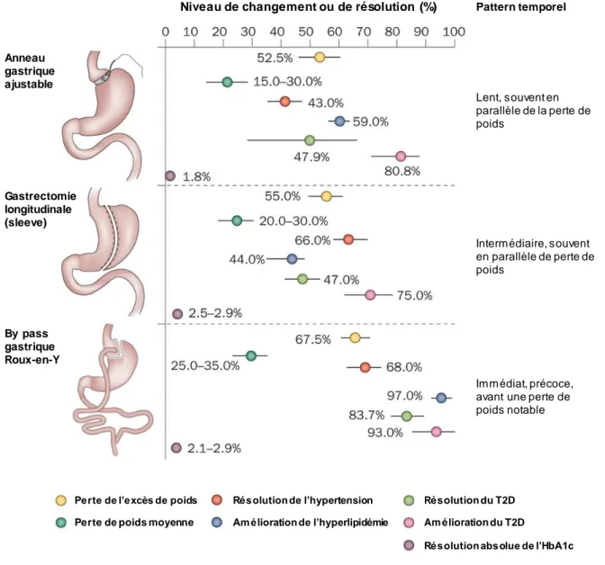 Figure 4. Les 3 principaux types de chirurgies bariatriques et leurs effets sur la perte de poids 