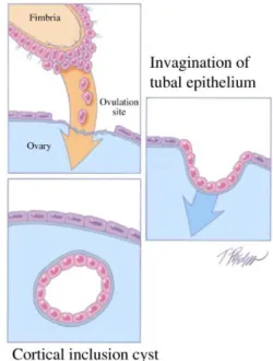 Figure 5 : développement d’un kyste d’inclusion cortical à partir de  l’épithélium tubaire selon Kurman et al. [9, 11] 