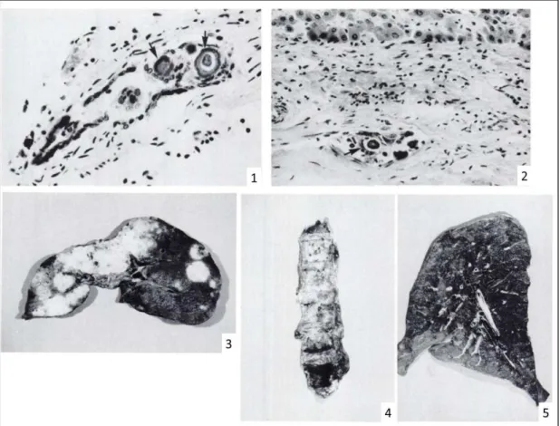 Figure 7 : Etude anatomique et histologique chez des patients traités par  shunt péritonéoveineux pour ascite réfractaire [33] 