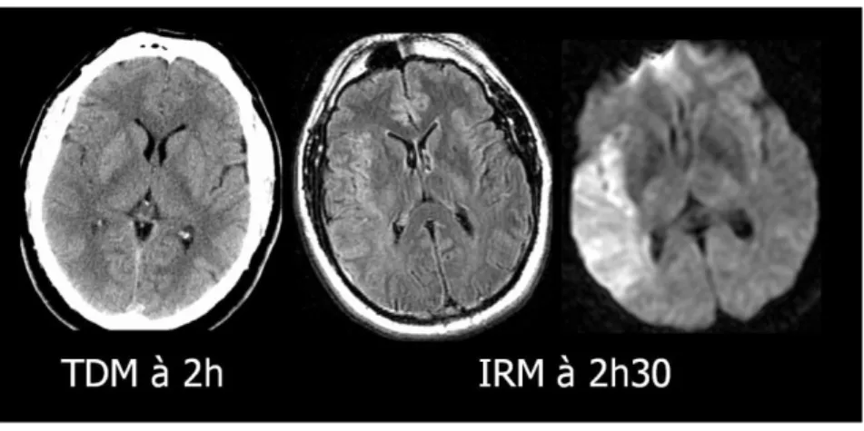 Figure 3 : Accident ischémique artériel aigu  