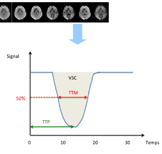 Figure 7 : Perfusion par étude du 1er passage d’un bolus de chélates de gadolinium  