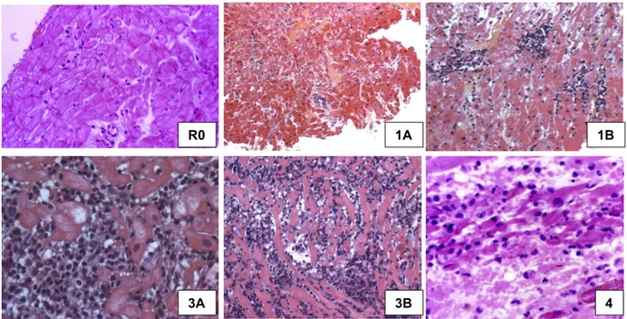 Figure  5.  Aspect  histologique  des  rejets  cellulaires :  de  R0  (absence  de  rejet)  à  4  (rejet cellulaire sévère), selon la classification de l’ISHLT 1990