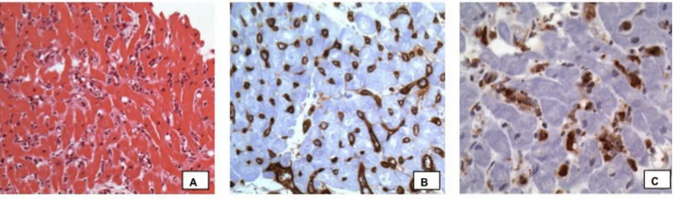 Figure 6. Image d’histologie et d’immunohistochimie permettant le diagnostic du rejet  humoral : histologie positive (A), avec infiltration macrophagique intravasculaire, C4d  positif  (B),  avec  un  marquage  endothélial,  CD68  positif  (C),  avec  un  