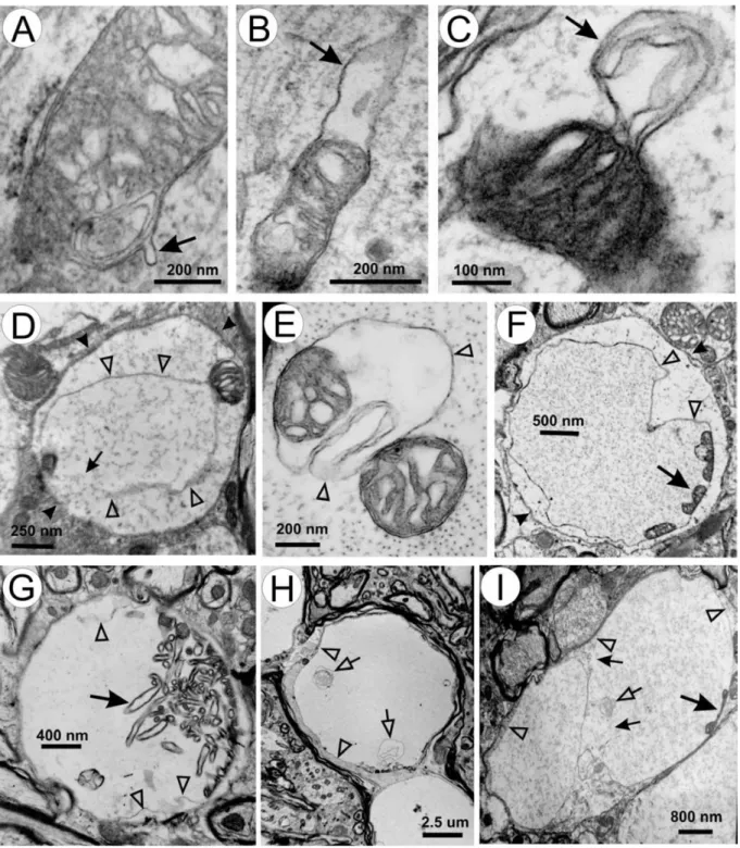 Figure  4  :  Exemples  de  vacuoles  mitochondriales.  A : Une petite vésicule de membrane externe 