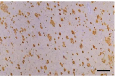 Figure 6 : Plaques séniles.   
