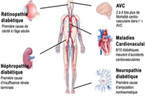 Figure 03 : Complications chroniques du diabète 