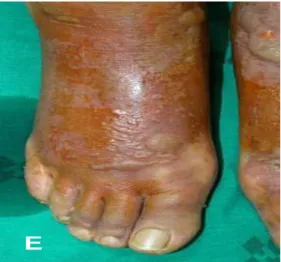 Figure 09 : Symptômes d’une phytophotodermatite causée par les feuilles de Ficus carica.