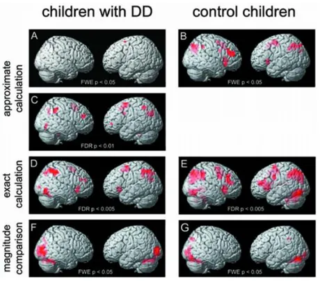 Figure 2 : Activation du cerveau d'enfants présentant une dyscalculie développementale et d'enfant tout-venant   (Kucian &amp; al., 2006, p.8) 