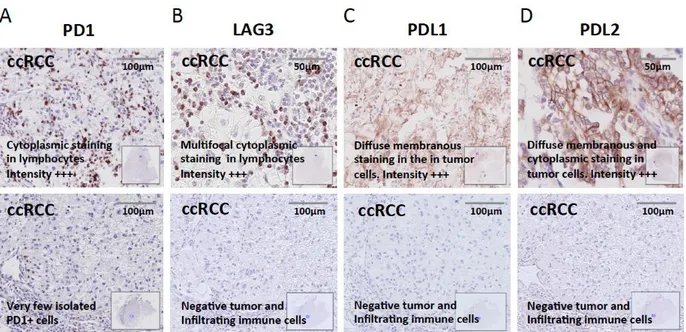 Figure  S3.  Representative  IHC  staining  of  immune  checkpoints  in  ccRCC  :  Immunohistochemical 